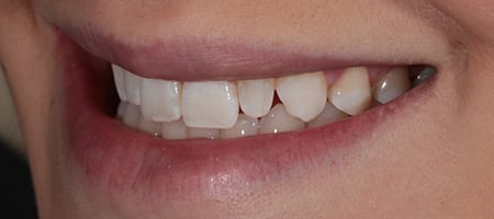 Before and After Bonding Treatment Wokingham