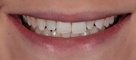 Before and After Bonding Treatment Wokingham