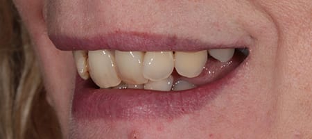 Before and After Bonding Treatment Wokingham