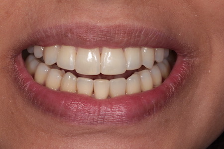 Before and After Invisalign Treatment Wokingham