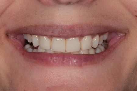Before and After Invisalign Treatment Wokingham
