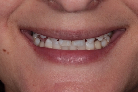 Before and After Invisalign Treatment Wokingham