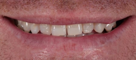 Before and After Bonding Treatment Wokingham