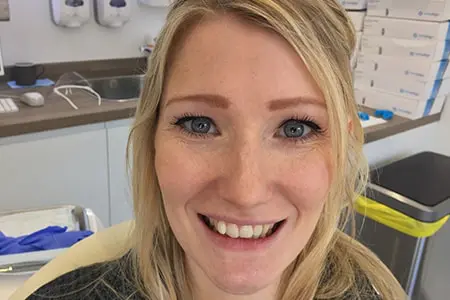 Before and After Invisalign Treatment Wokingham Before and After Invisalign Treatment Wokingham