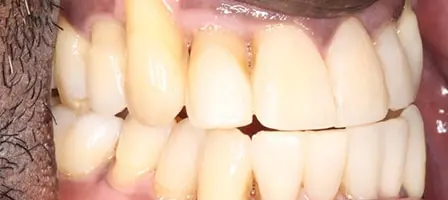 Before and After Invisalign Treatment Wokingham Before and After Invisalign Treatment Wokingham