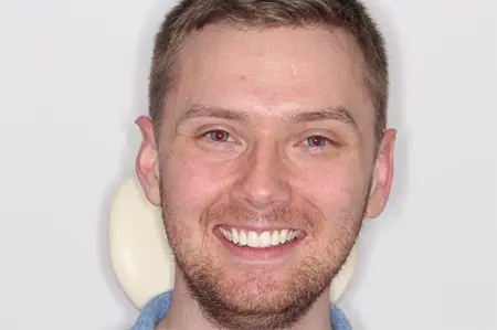 Before and After Invisalign Treatment Wokingham Before and After Invisalign Treatment Wokingham