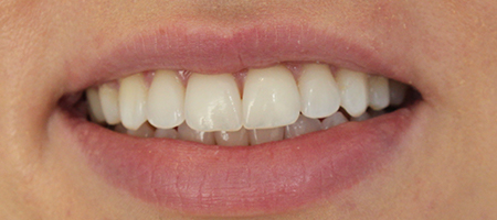 Before and After Invisalign Treatment Wokingham Before and After Invisalign Treatment Wokingham