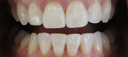 Before and After Invisalign Treatment Wokingham Before and After Invisalign Treatment Wokingham