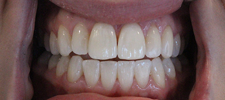 Before and After Invisalign Treatment Wokingham Before and After Invisalign Treatment Wokingham