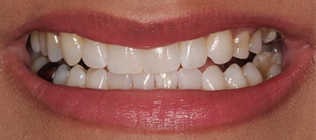 Before and After Invisalign Treatment Wokingham Before and After Invisalign Treatment Wokingham