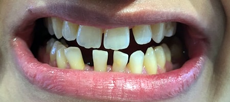 Before and After Invisalign Treatment Wokingham Before and After Invisalign Treatment Wokingham