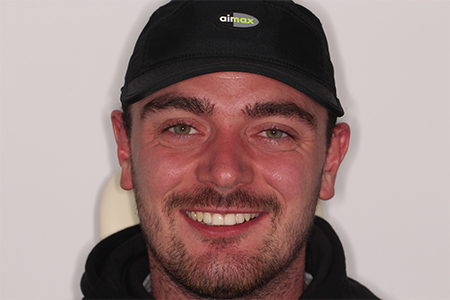 Before and After Invisalign Treatment Wokingham Before and After Invisalign Treatment Wokingham