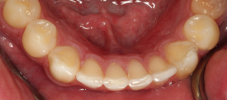 Before and After Invisalign Treatment Wokingham Before and After Invisalign Treatment Wokingham