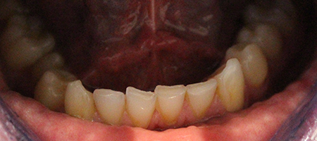 Before and After Invisalign Treatment Wokingham Before and After Invisalign Treatment Wokingham