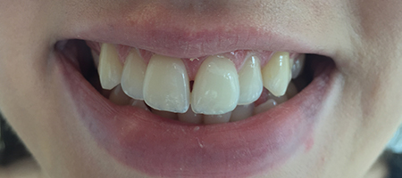 Before and After Invisalign Treatment Wokingham Before and After Invisalign Treatment Wokingham