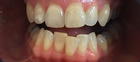 Before and After Invisalign Treatment Wokingham Before and After Invisalign Treatment Wokingham