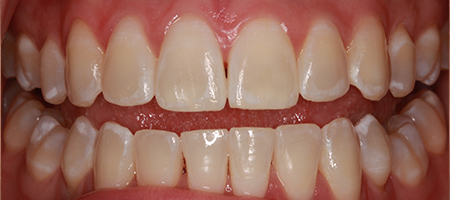 Before and After Invisalign Treatment Wokingham Before and After Invisalign Treatment Wokingham