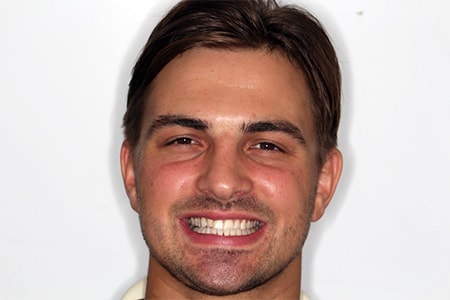 Before and After Invisalign Treatment Wokingham Before and After Invisalign Treatment Wokingham