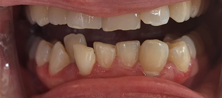 Before and After Invisalign Treatment Wokingham Before and After Invisalign Treatment Wokingham