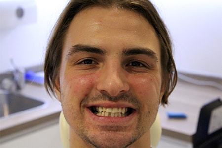 Before and After Invisalign Treatment Wokingham Before and After Invisalign Treatment Wokingham