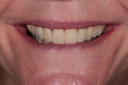 Before and After Invisalign Treatment Wokingham