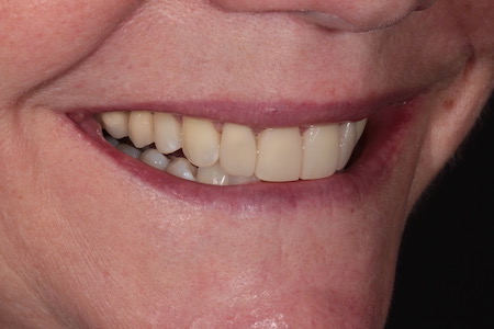 Before and After Invisalign Treatment Wokingham