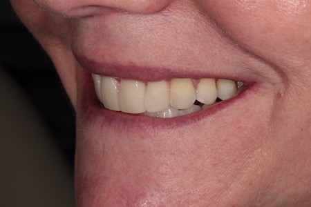 Before and After Invisalign Treatment Wokingham