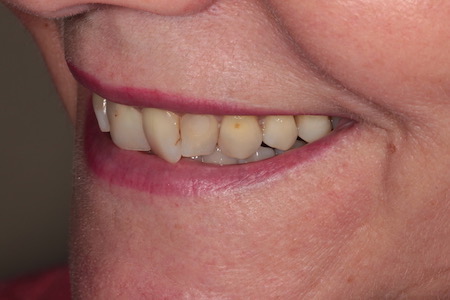 Before and After Invisalign Treatment Wokingham