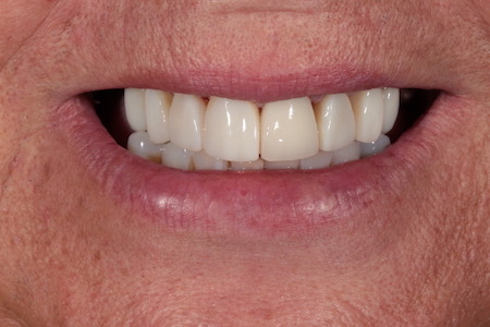 Before and After Invisalign Treatment Wokingham