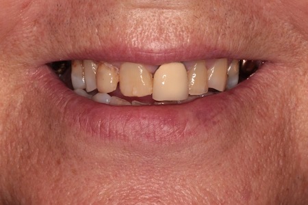 Before and After Invisalign Treatment Wokingham