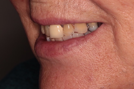 Before and After Invisalign Treatment Wokingham