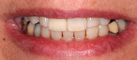 Before and After Invisalign Treatment Wokingham