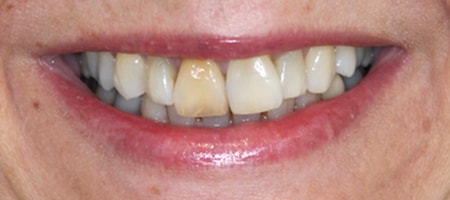 Before and After Invisalign Treatment Wokingham