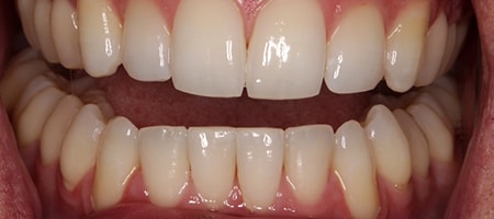 Before and After Invisalign Treatment Wokingham Before and After Invisalign Treatment Wokingham