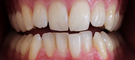 Before and After Invisalign Treatment Wokingham Before and After Invisalign Treatment Wokingham