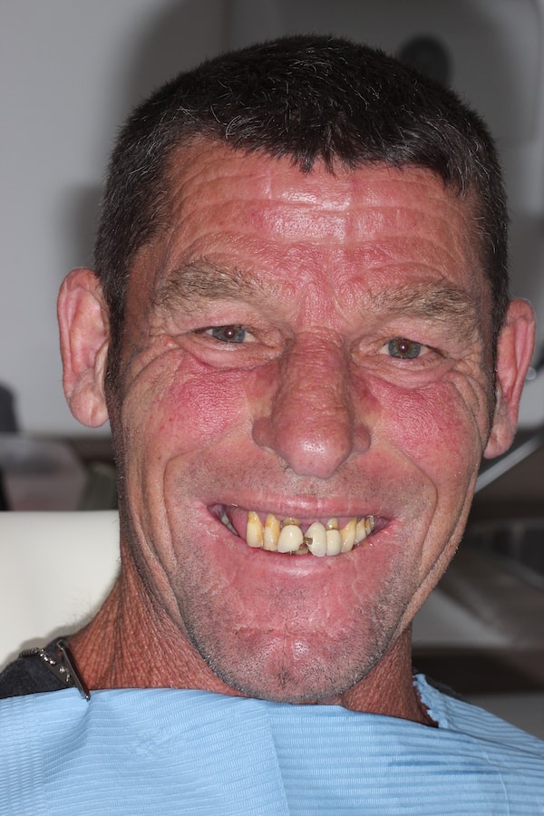 Before and After Implants Treatment Wokingham