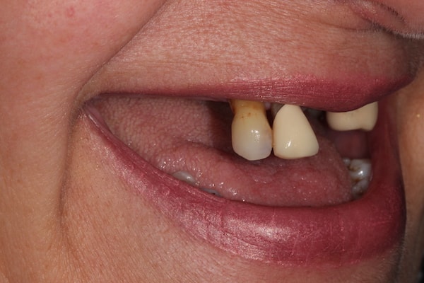 Before and After Implants Treatment Wokingham