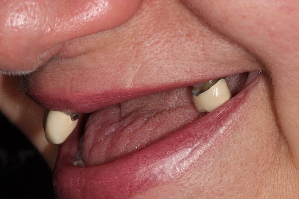 Before and After Implants Treatment Wokingham
