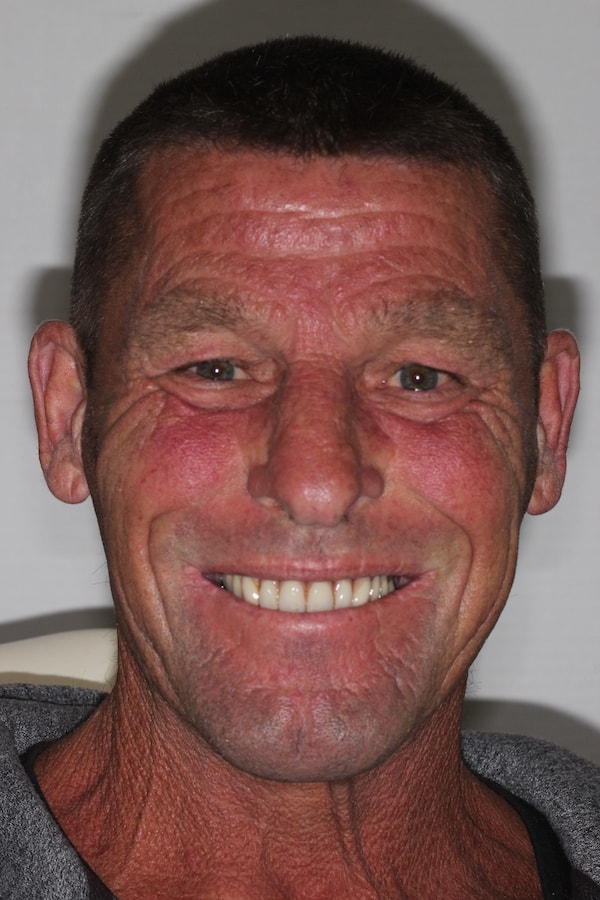 Before and After Implants Treatment Wokingham