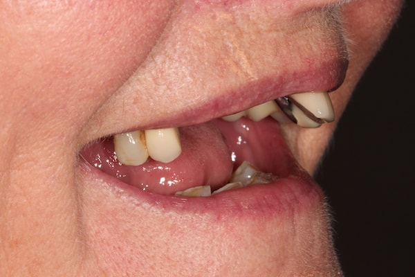 Before and After Implants Treatment Wokingham