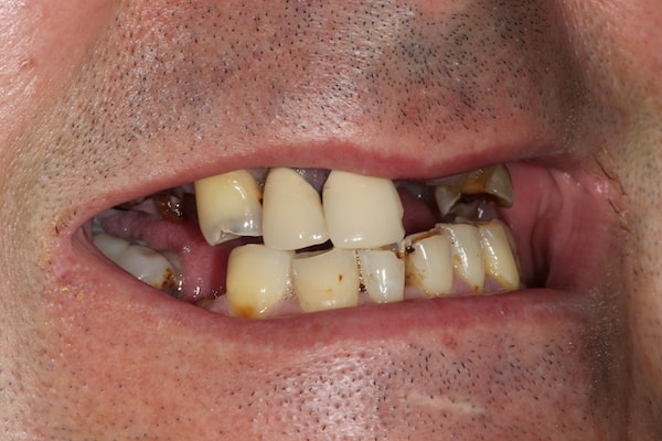 Before and After Implants Treatment Wokingham