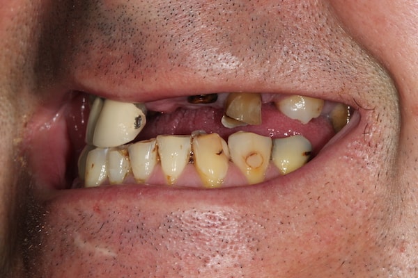 Before and After Implants Treatment Wokingham