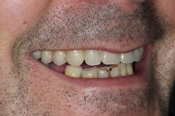 Before and After Implants Treatment Wokingham