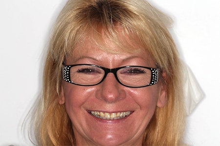 Before and After Invisalign Treatment Wokingham