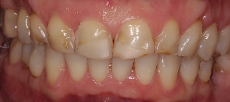 Before and After Invisalign Treatment Wokingham