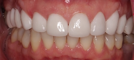 Before and After Invisalign Treatment Wokingham