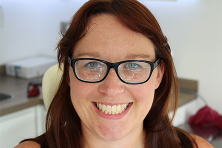 Before and After Invisalign Treatment Wokingham Before and After Invisalign Treatment Wokingham