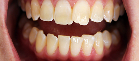 Before and After Invisalign Treatment Wokingham Before and After Invisalign Treatment Wokingham