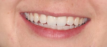 Before and After Invisalign Treatment Wokingham Before and After Invisalign Treatment Wokingham