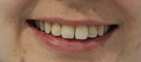 Before and After Invisalign Treatment Wokingham Before and After Invisalign Treatment Wokingham